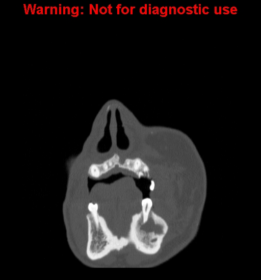 File:Ameloblastoma (Radiopaedia 13276-13280 Coronal non-contrast 1).jpg