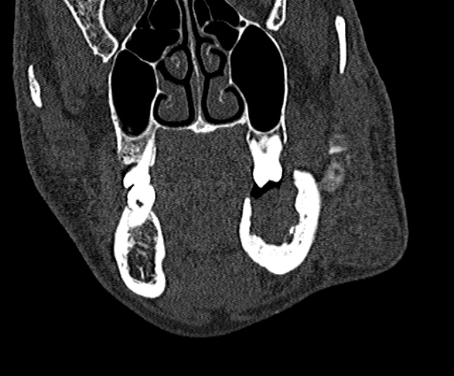 Ameloblastoma (Radiopaedia 51921-57766 Coronal bone window 88).jpg
