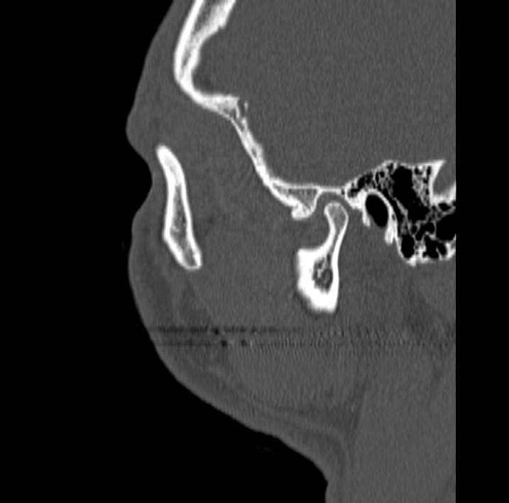 Ameloblastoma (Radiopaedia 77750-89997 Sagittal bone window 119).jpg