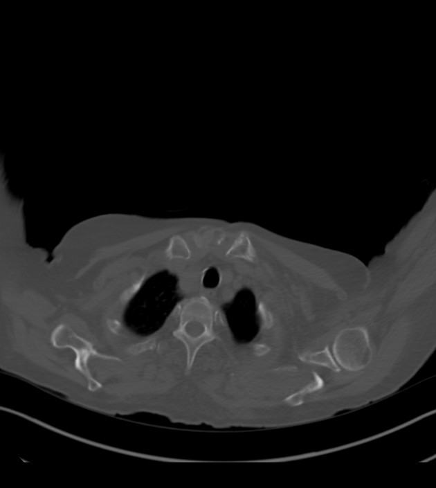 Amiodarone deposition in the liver (Radiopaedia 77587-89780 Axial bone window 10).jpg