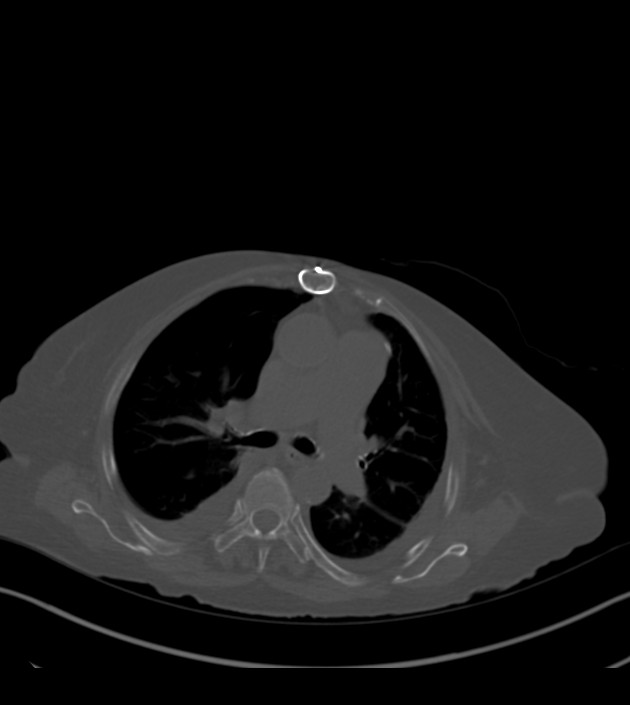 Amiodarone deposition in the liver (Radiopaedia 77587-89780 Axial bone window 34).jpg