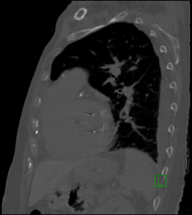 Amiodarone deposition in the liver (Radiopaedia 77587-89780 Sagittal bone window 34).jpg