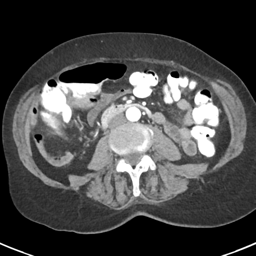 Ampullary adenocarcinoma (Radiopaedia 34013-35237 B 53).png