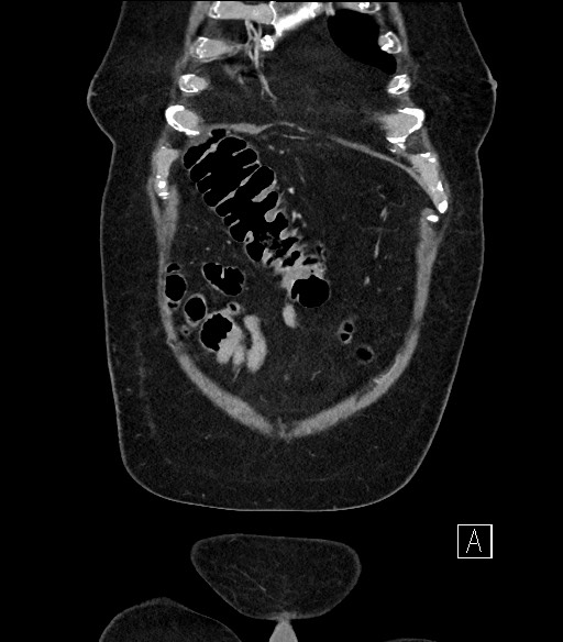 Ampullary adenocarcinoma (Radiopaedia 59373-66734 D 2).jpg