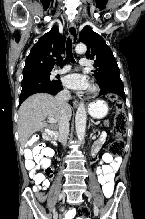 Ampullary adenocarcinoma (Radiopaedia 86093-102033 D 32).jpg