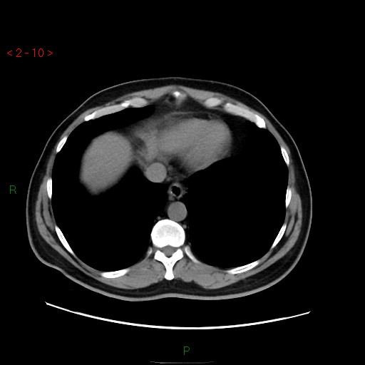 File:Ampullary carcinoma (Radiopaedia 56396-63056 Axial non-contrast 7).jpg