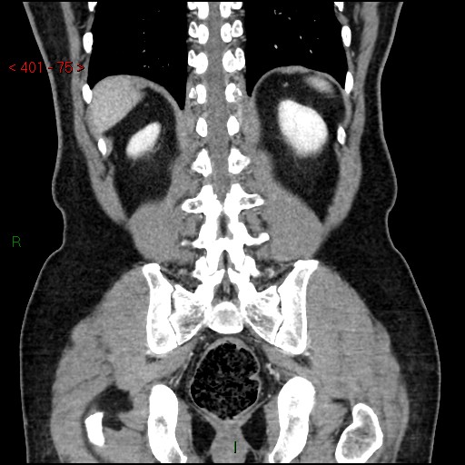 Ampullary carcinoma (Radiopaedia 56396-63056 E 74).jpg