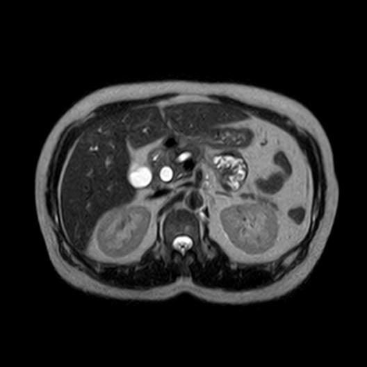 File:Ampullary tumor (Radiopaedia 27294-27479 T2 12).jpg
