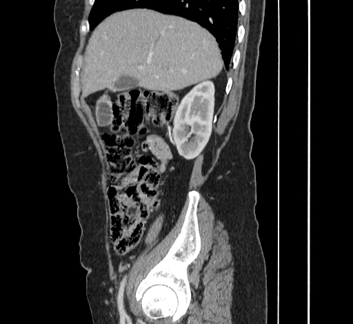File:Ampullary tumor (Radiopaedia 60333-67998 C 13).jpg