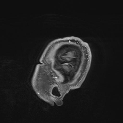 Amyloid angiopathy with inflammation (Radiopaedia 30360-31002 M 7).jpg