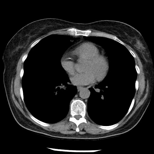 Amyloidosis - bronchial and diffuse nodular pulmonary involvement (Radiopaedia 60156-67744 Axial non-contrast 35).jpg