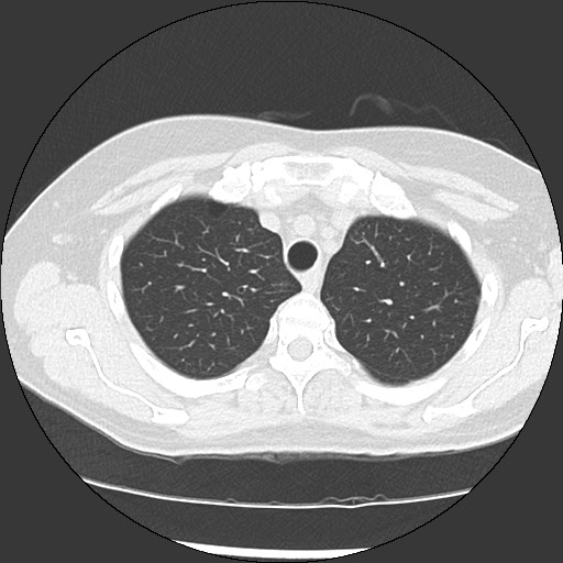 Amyloidosis - bronchial and diffuse nodular pulmonary involvement (Radiopaedia 60156-67744 B 13).jpg