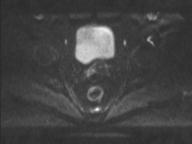 Anal adenocarcinoma - tumor regression grade 1 (Radiopaedia 31358-32100 Axial DWI 51).jpg