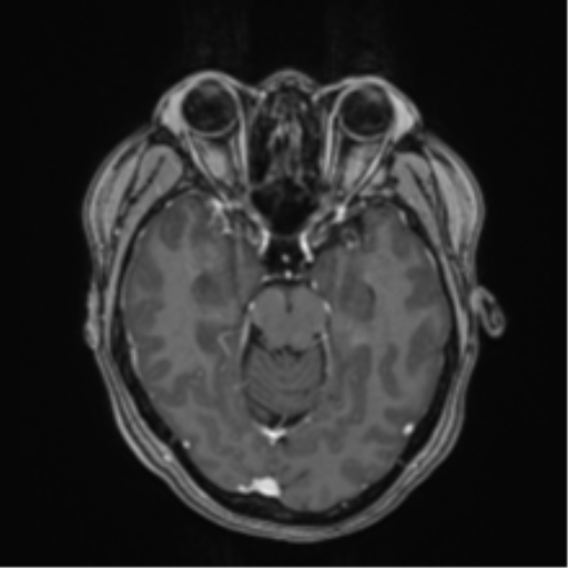 Anaplastic astroblastoma (Radiopaedia 55666-62194 Axial T1 C+ 28).png