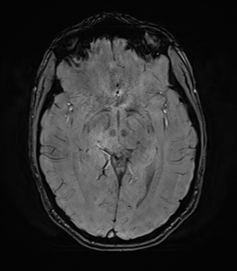 File:Anaplastic astrocytoma IDH mutant (Radiopaedia 50046-55341 Axial SWI 41).png