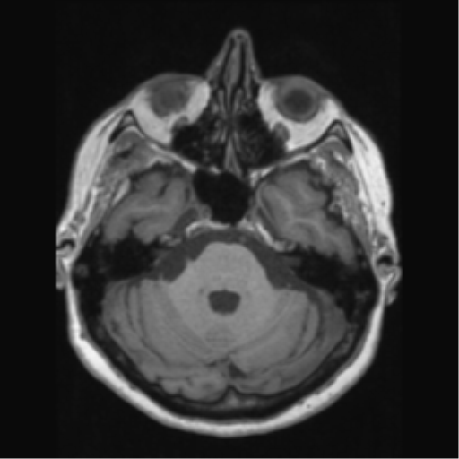 File:Anaplastic astrocytoma IDH wild-type (pseudoprogression) (Radiopaedia 42209-45276 Axial T1 48).png