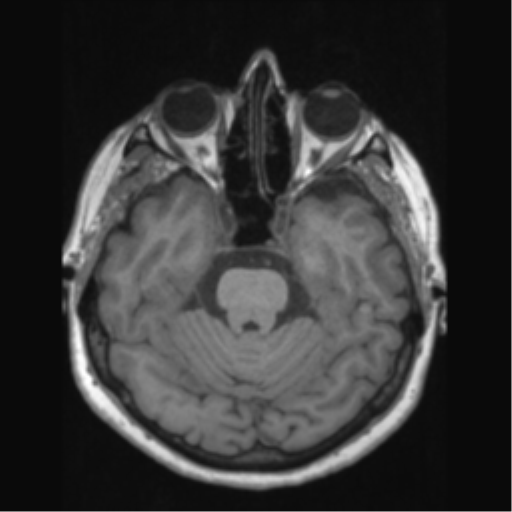 Anaplastic astrocytoma IDH wild-type (pseudoprogression) (Radiopaedia 42209-45276 Axial T1 55).png