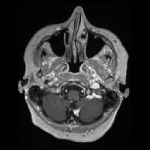 File:Anaplastic astrocytoma IDH wild-type (pseudoprogression) (Radiopaedia 42209-45276 Axial T1 C+ 24).png