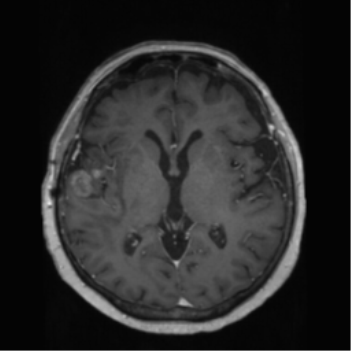 File:Anaplastic astrocytoma IDH wild-type (pseudoprogression) (Radiopaedia 42209-45278 Axial T1 C+ 83).png