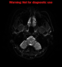 File:Anaplastic ganglioglioma (Radiopaedia 44921-48831 Axial DWI 33).jpg