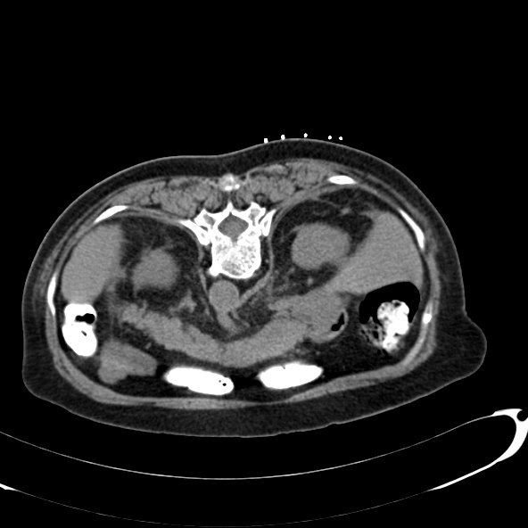 File:Anaplastic lymphoma - with CT biopsy (Radiopaedia 21643-21602 Axial non-contrast 15).jpg