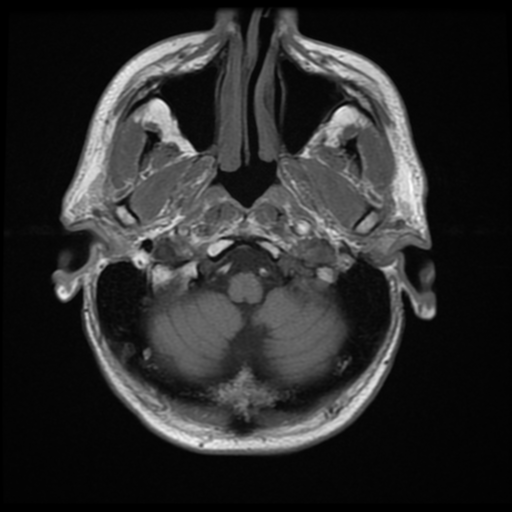 File:Anaplastic meningioma with recurrence (Radiopaedia 34452-35791 Axial T1 2).png
