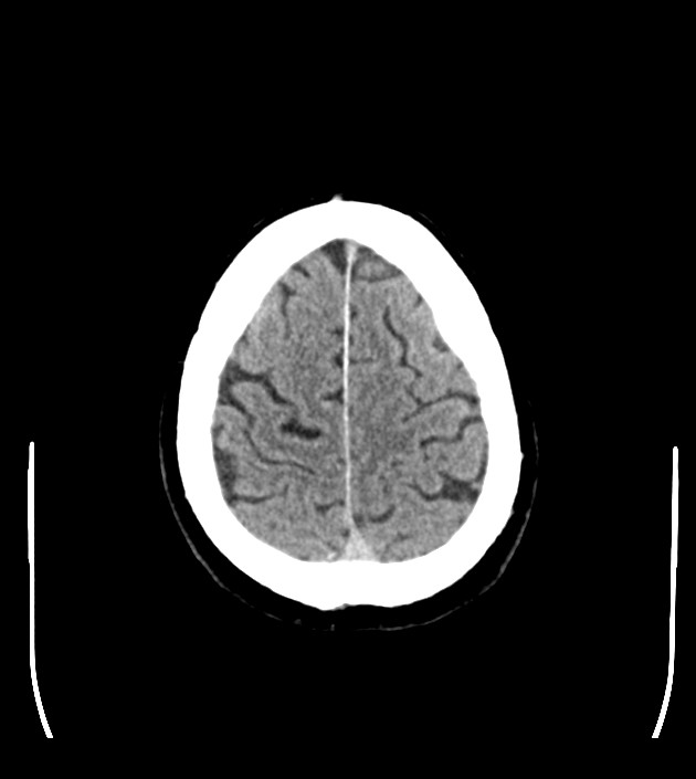 Anaplastic oligodendroglioma (Radiopaedia 79571-92753 Axial non-contrast 45).jpg