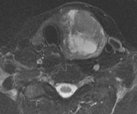 File:Anaplastic thyroid cancer (MRI) (Radiopaedia 13728-13611 Axial T2 fat sat 1).jpg