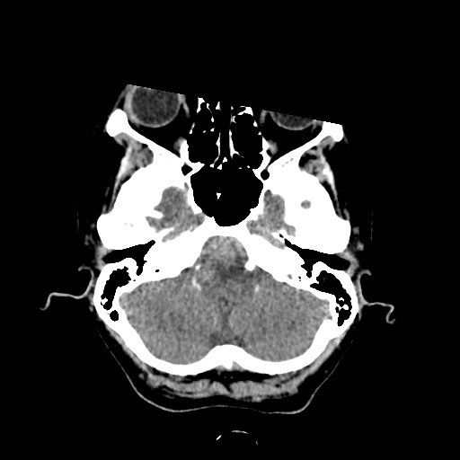 Aneursym related subarachnoid hemorrhage with hydrocephalus (Radiopaedia 45105-49083 Axial non-contrast 6).jpg