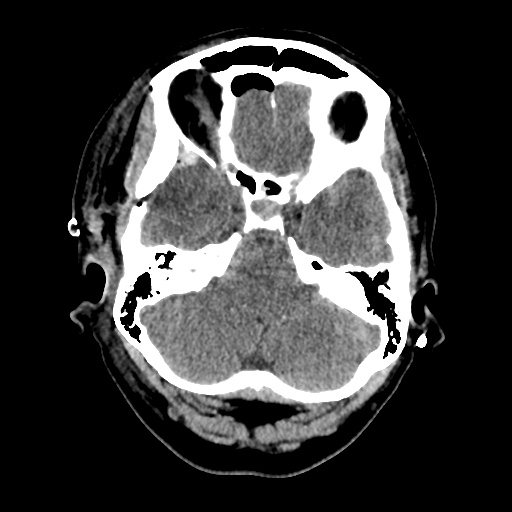 File:Aneursym related subarachnoid hemorrhage with hydrocephalus (Radiopaedia 45105-49085 Axial non-contrast 10).jpg