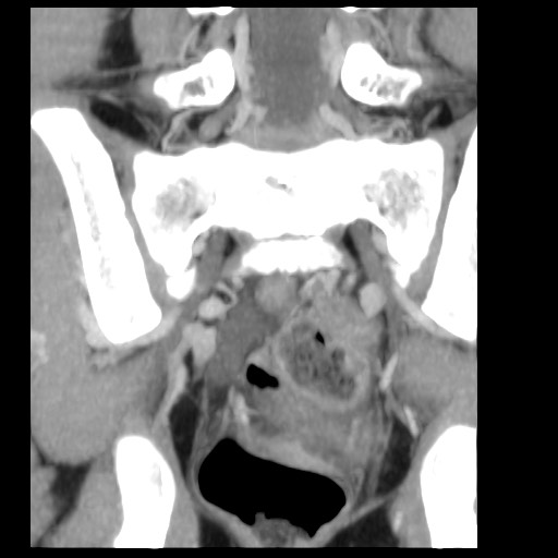 File:Aneurysmal bone cyst - sacrum (Radiopaedia 65190-74195 D 4).jpg