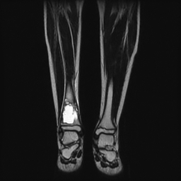 File:Aneurysmal bone cyst - tibia (Radiopaedia 22343-22367 Coronal T2 9).jpg