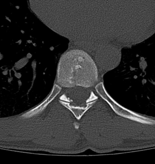 Aneurysmal bone cyst T11 (Radiopaedia 29294-29721 Axial bone window 18).jpg