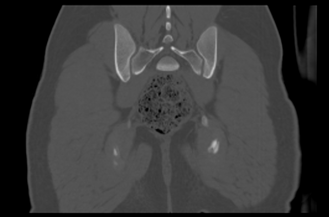 File:Aneurysmal bone cyst of ischium (Radiopaedia 25957-26094 Coronal bone window 36).png