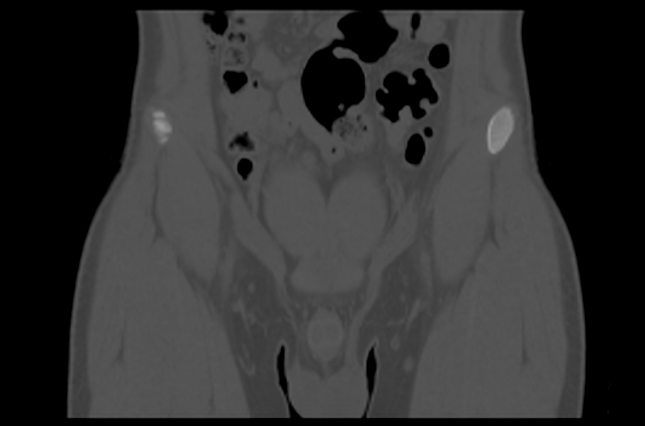 File:Aneurysmal bone cyst of ischium (Radiopaedia 25957-26094 Coronal bone window 4).png