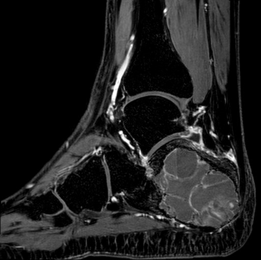 File:Aneurysmal bone cyst of the calcaneus (Radiopaedia 60669-68420 F 17).jpg