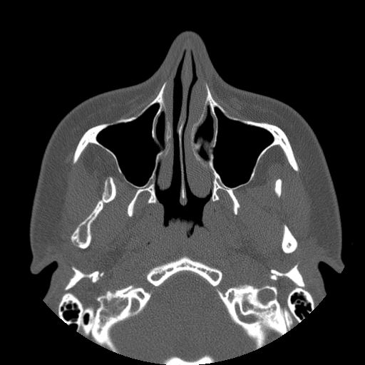 Aneurysmal bone cyst of the mandible (Radiopaedia 43280-46823 Axial bone window 124).jpg