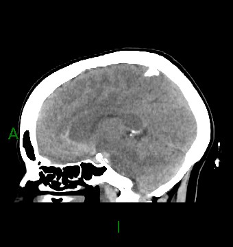 File:Aneurysmal subarachnoid hemorrhage with intra-axial extension (Radiopaedia 84371-99699 B 26).jpg