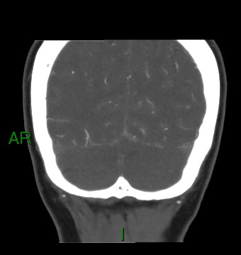 Aneurysmal subarachnoid hemorrhage with intra-axial extension (Radiopaedia 84371-99732 C 21).jpg