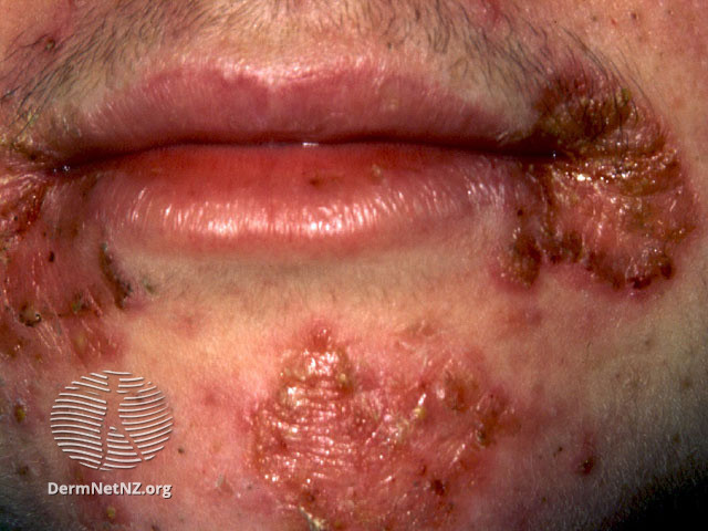 File:Angular cheilitis (DermNet NZ site-age-specific-perleche5).jpg