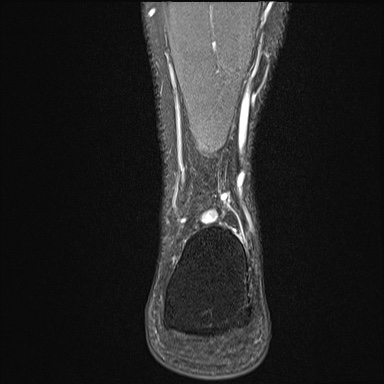 Ankle syndesmotic injury (Radiopaedia 69066-78837 Coronal PD fat sat 10).jpg