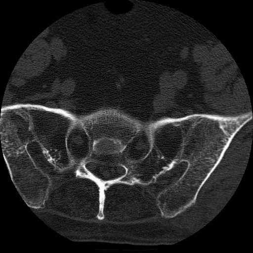 Ankylosing spondylitis complicated by fracture-dislocation (Radiopaedia 33583-34674 Axial non-contrast 164).jpg