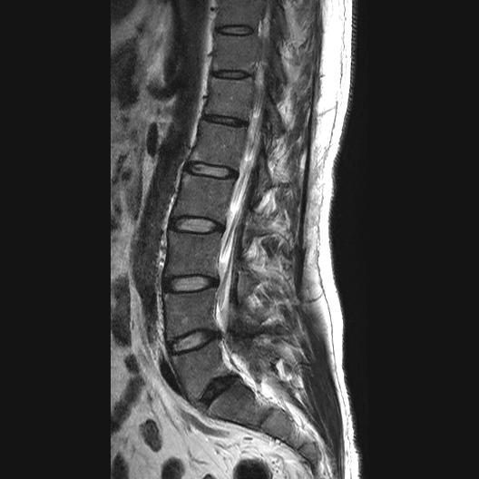 File:Ankylosing spondylitis with zygapophyseal arthritis (Radiopaedia 38433-40516 Sagittal T2 4).jpg