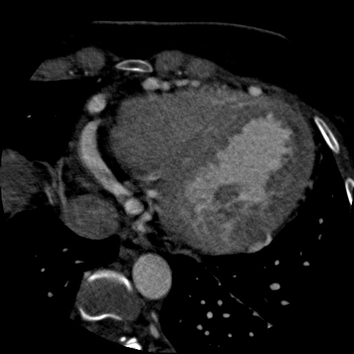 Anomalous left coronary artery from the pulmonary artery (ALCAPA) (Radiopaedia 40884-43586 A 66).jpg
