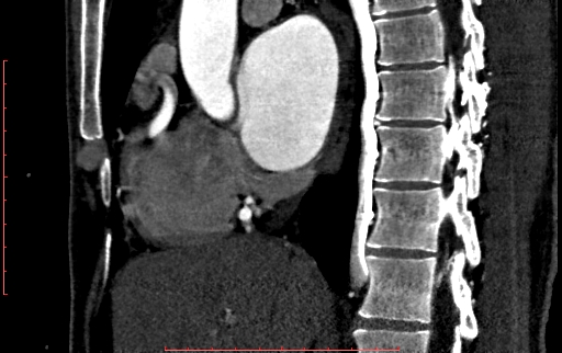 File:Anomalous left coronary artery from the pulmonary artery (ALCAPA) (Radiopaedia 70148-80181 C 89).jpg