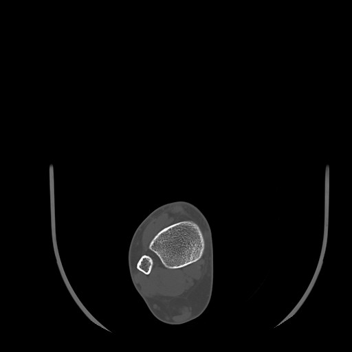 Anterior calcaneal process fracture (Radiopaedia 82590-96762 Axial bone window 4).jpg