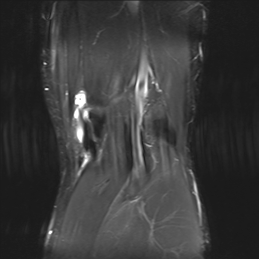 File:Anterior cruciate ligament full thickness tear (Radiopaedia 66268-75467 Coronal STIR 18).jpg