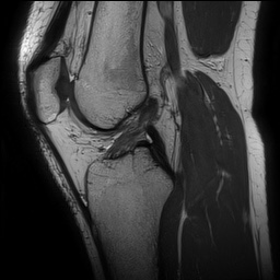 Anterior cruciate ligament rupture and posteromedial corner injury (Radiopaedia 67338-76723 Sagittal PD 86).jpg