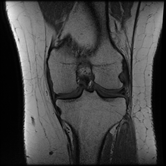 File:Anterior cruciate ligament tear, Wrisberg rip and bucket-handle tear of medial meniscus (Radiopaedia 75872-87266 Coronal T1 17).jpg