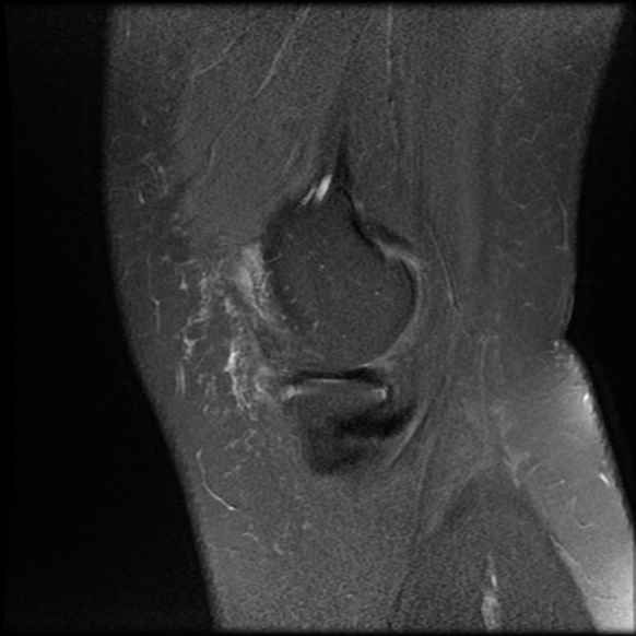 File:Anterior cruciate ligament tear, Wrisberg rip and bucket-handle tear of medial meniscus (Radiopaedia 75872-87266 Sagittal PD fat sat 23).jpg